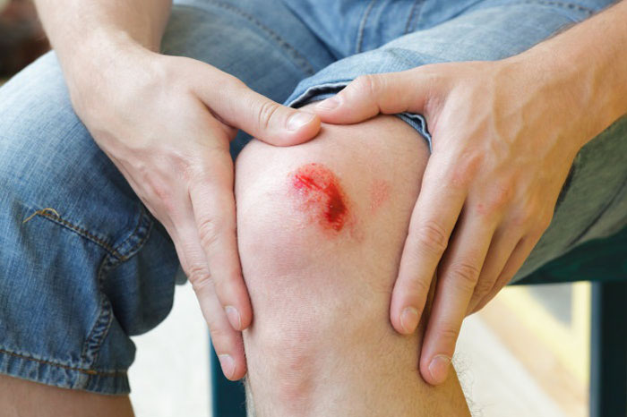 10 ماده طبیعی درمانگر انواع زخم